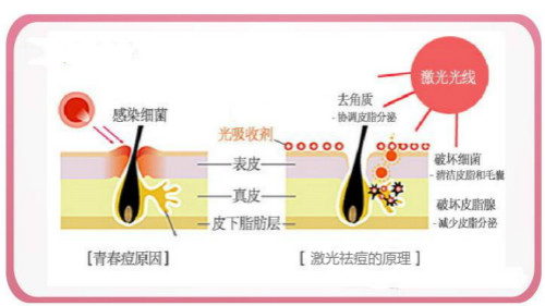 激光祛痘術后護理,激光祛痘時間,激光祛痘效果,激光祛痘儀器
