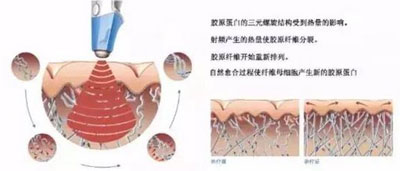 減肥/抗衰兩不誤，BTL溶脂刀儀器一次滿足你