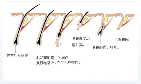 脫毛為什么一次性脫不干凈？原因在這里