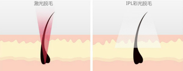 激光脫毛儀和IPL彩光脫毛儀的區別