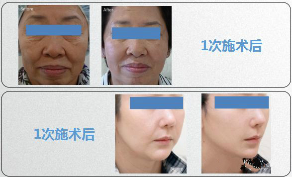 雷達(dá)精雕儀：一臺(tái)顛覆傳統(tǒng)和現(xiàn)有抗衰方式的美容儀器