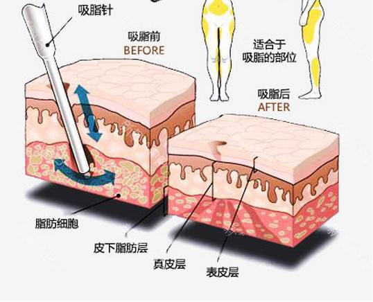 用核磁儀器爆脂減肥？只是一個噱頭而已