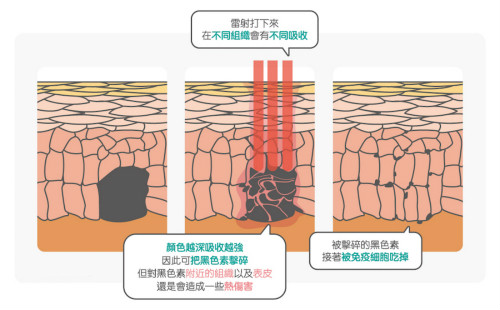 激光儀器美白淡斑：凈膚激光、粉餅激光、光纖激光比較及注意事項(xiàng)