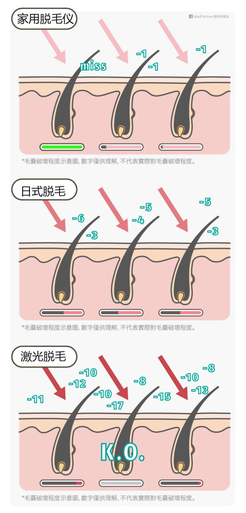 日式脫毛、家用脫毛儀及激光脫毛的功效價格大評比