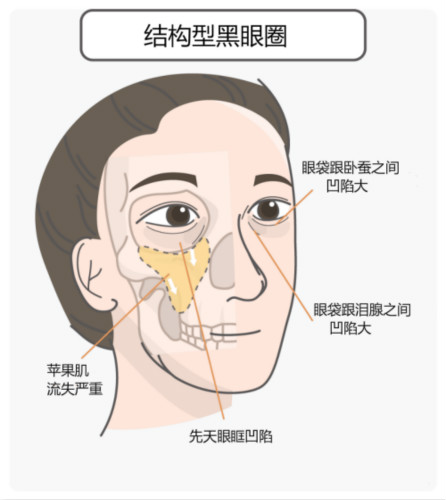 區(qū)分黑眼圈！黑眼圈的成因、分類、預(yù)防與治療全攻略