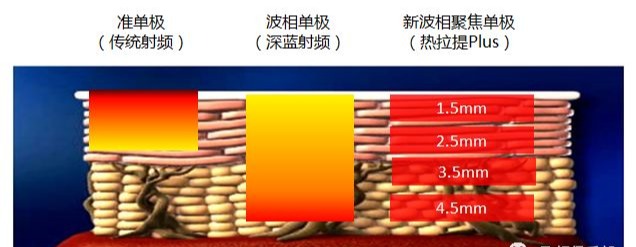 射頻醫(yī)美抗衰發(fā)展史！射頻美容儀到底哪里好？