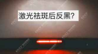 激光祛斑之后皮膚會反黑？美容儀器廠家教你這樣預防