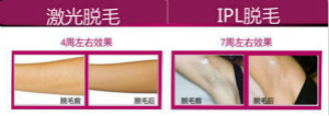 【激光脫毛】風(fēng)險(xiǎn)一定要留意