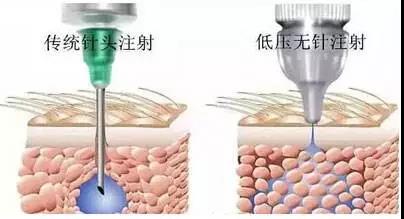 無(wú)創(chuàng)水光儀的出現(xiàn)可否取代水光針的治療呢